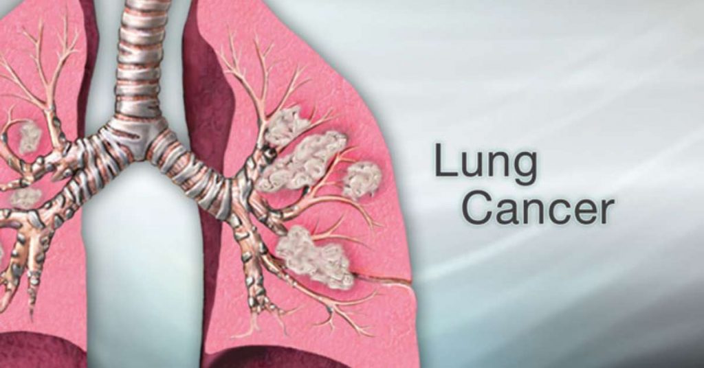 Lung-Cancer