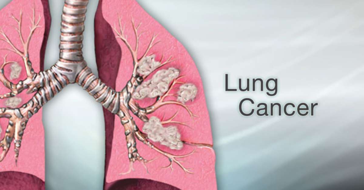 Lung Cancer Research